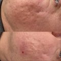Отзыв о Коллагеновый комплекс Коллост: Замечательный препарат!