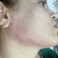 Избавилась от рубцов с помощью геля Коллост и шлифовки