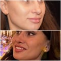 Ринопластика